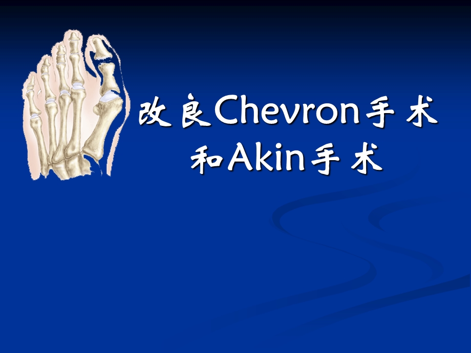 改良CHEVRON手术和AKIN手术.ppt_第1页