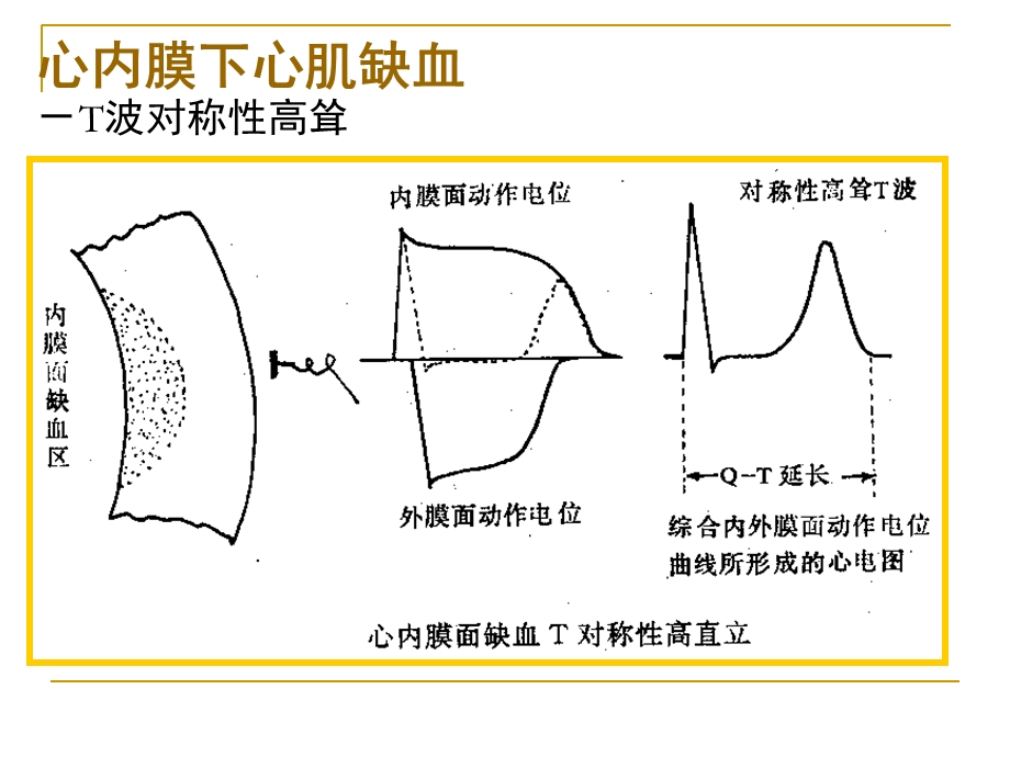 第四次课心肌缺血梗塞.ppt_第2页