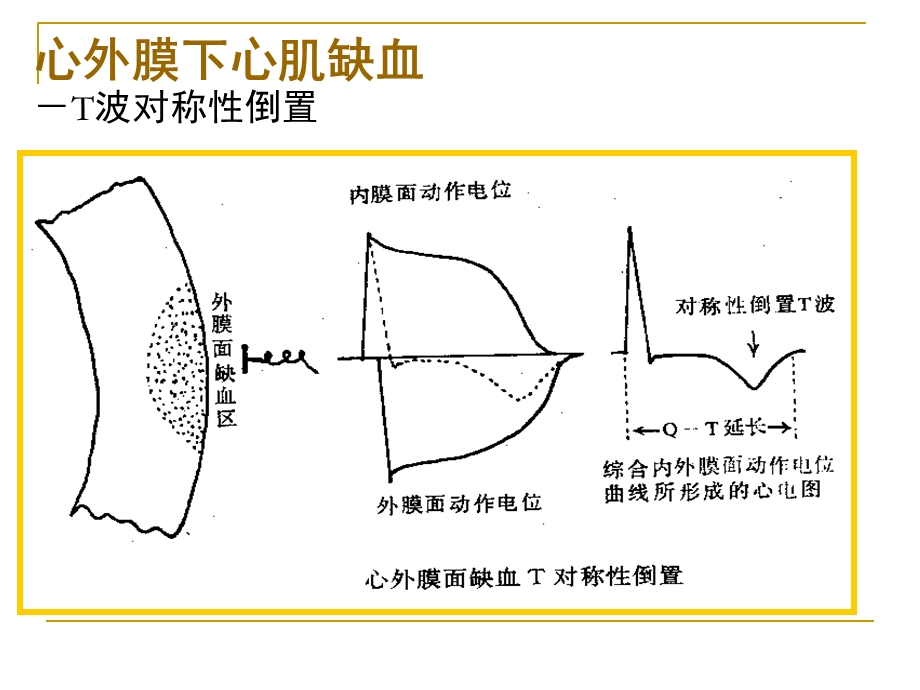 第四次课心肌缺血梗塞.ppt_第3页