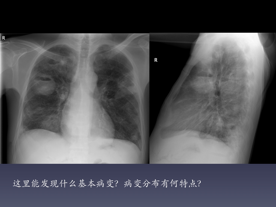 影诊讨论课03肺部炎症与不明原因肺部疾病2学生版.ppt_第3页