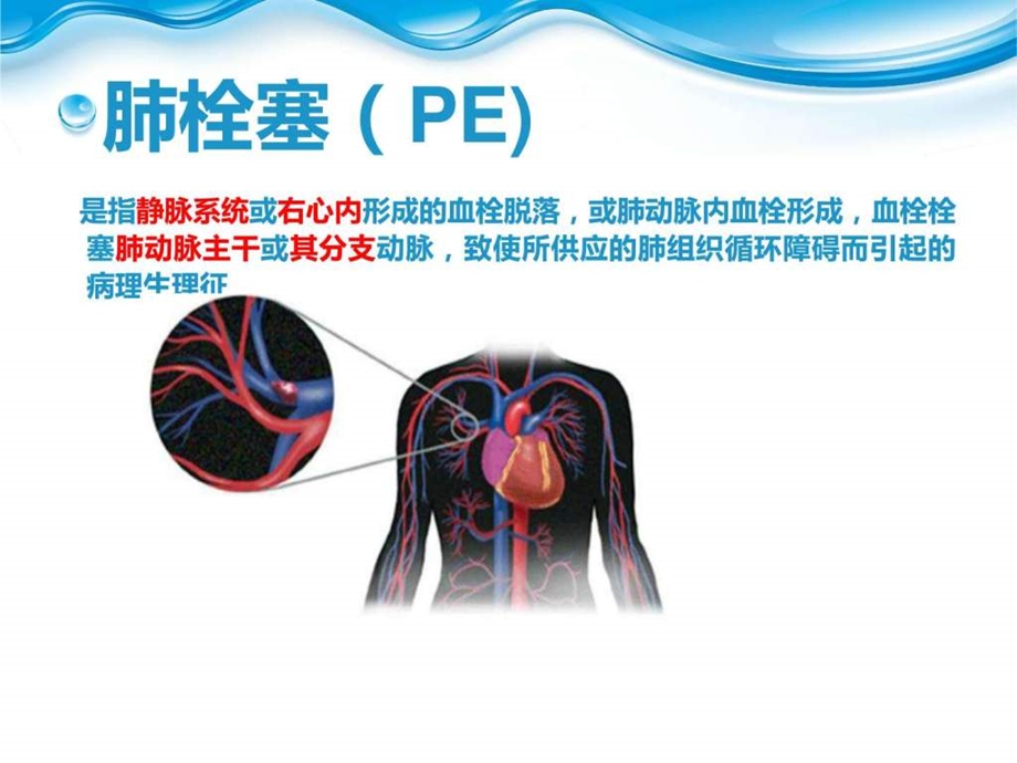 肺栓塞病人护理ppt课件图文.ppt.ppt_第3页