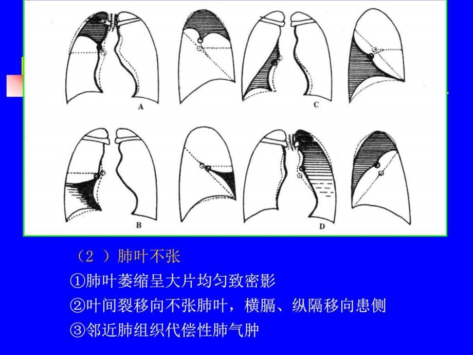 肺叶不张图文.ppt.ppt_第1页