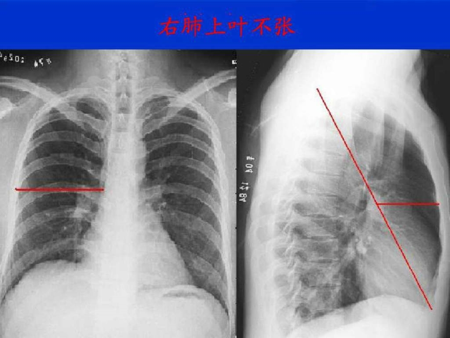 肺叶不张图文.ppt.ppt_第3页