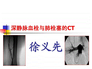 肺栓塞的CT.ppt.ppt