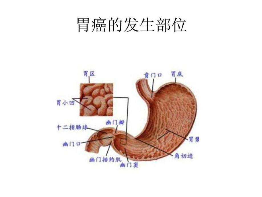 胃癌常见手术方式图文1799486444.ppt.ppt_第3页