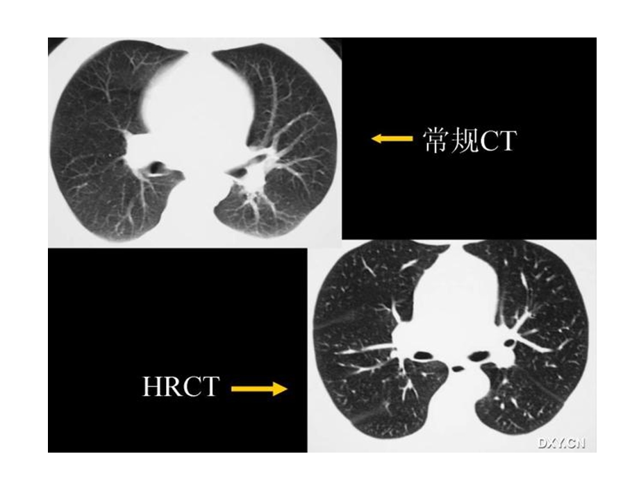 HRCT在弥漫性肺病诊断中的应用.ppt_第3页