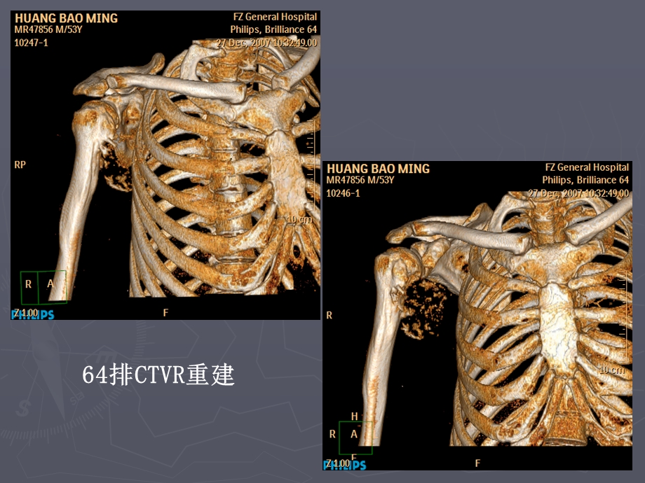 软骨肉瘤1例文档资料.ppt_第3页