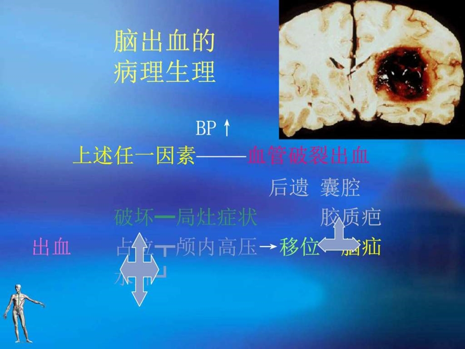 6脑出血图文.ppt16.ppt_第3页