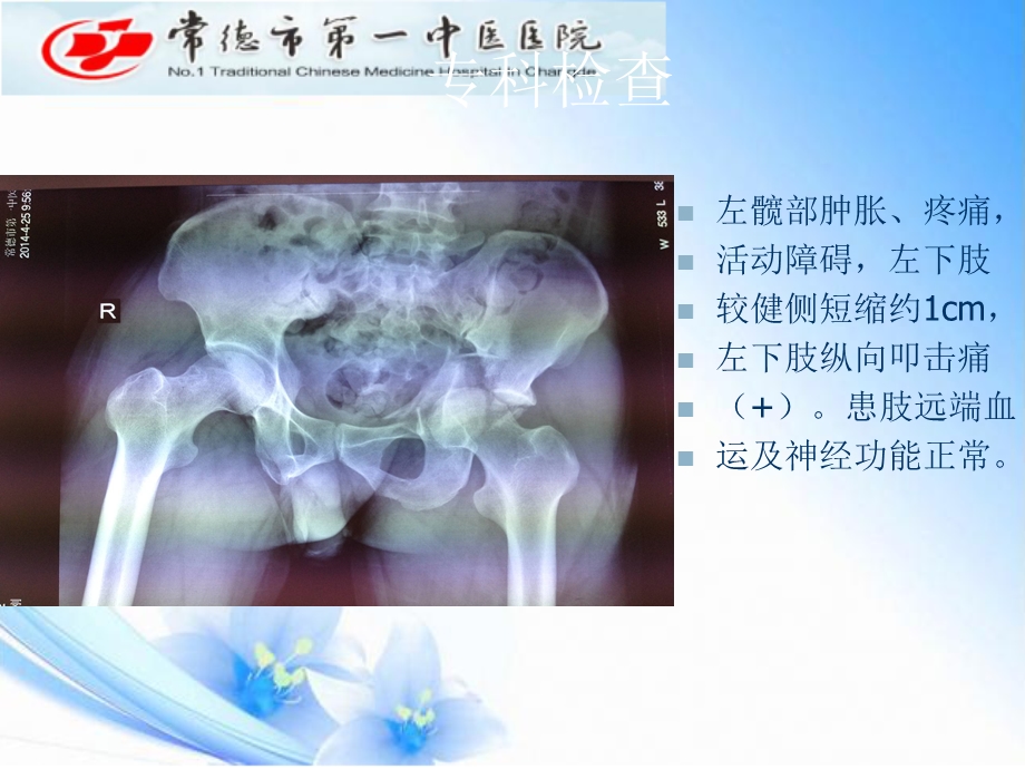 髋臼骨折王健ppt课件.ppt_第2页