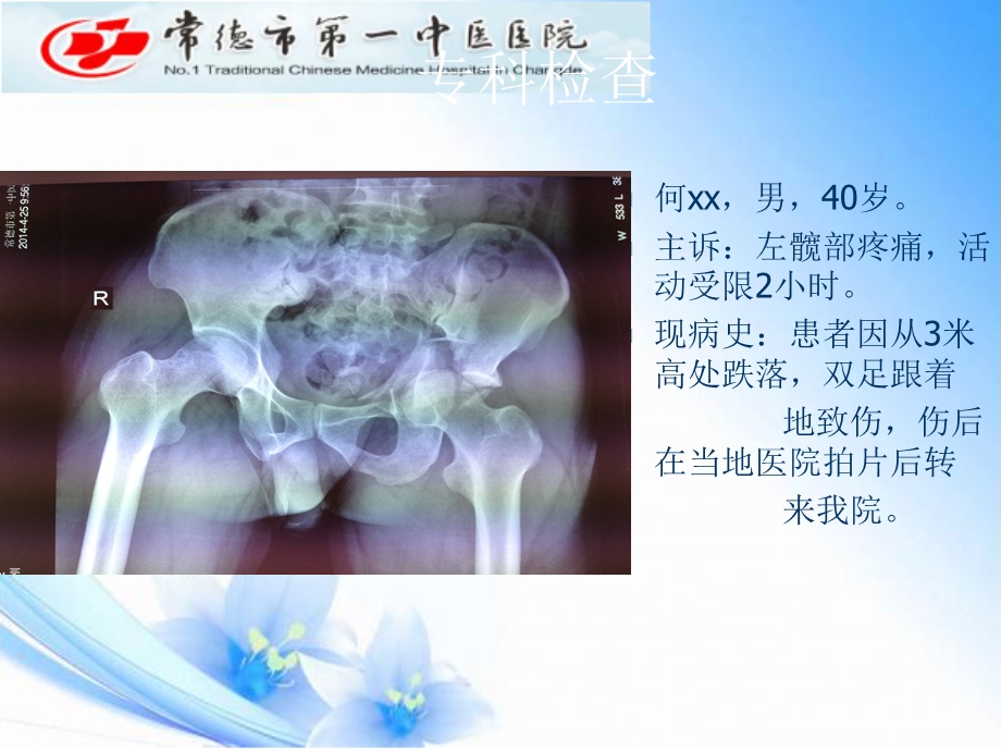 髋臼骨折王健ppt课件.ppt_第3页