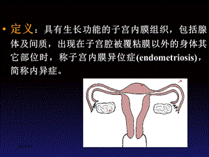 【医药健康】中医妇科学子宫内膜异位症PPT文档.ppt