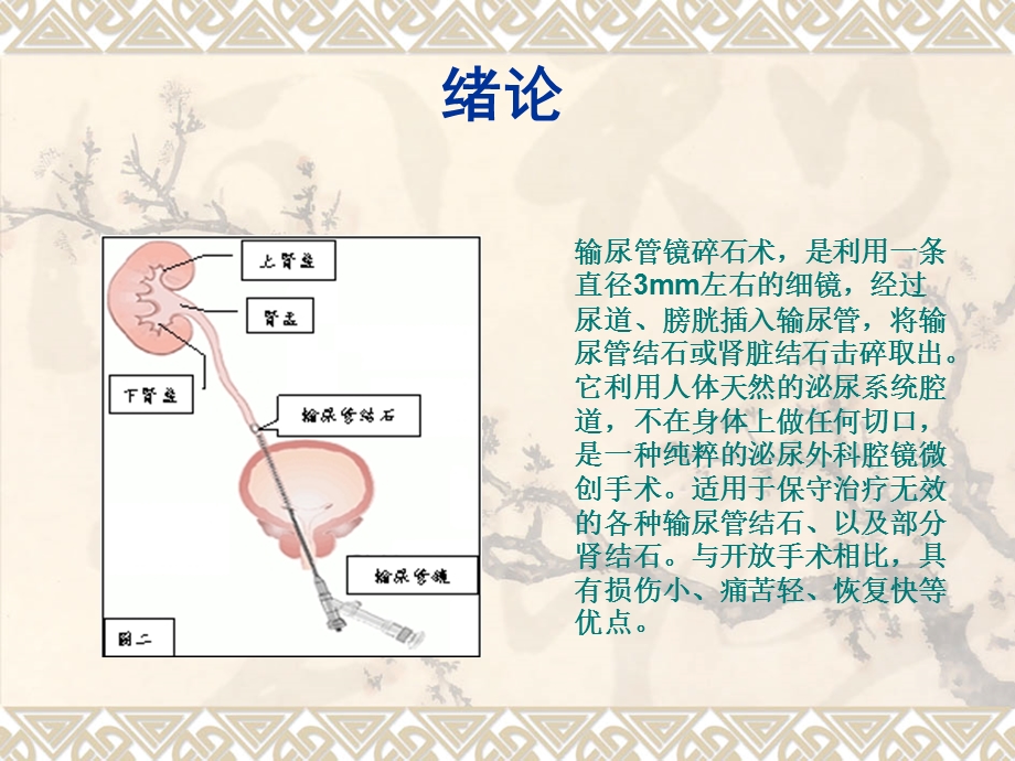 输尿管镜碎石术.ppt_第2页