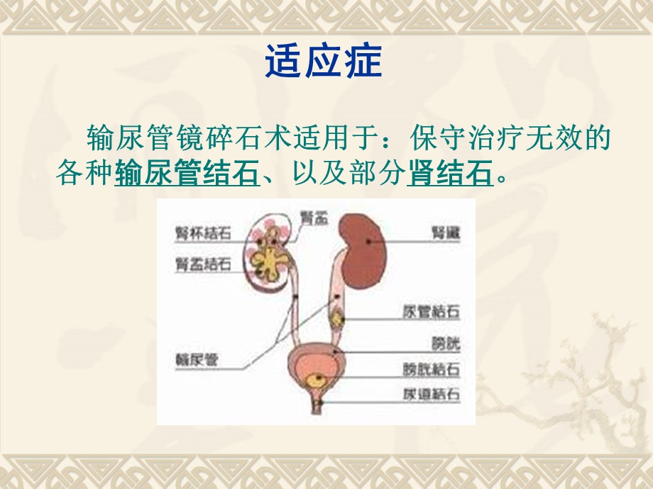 输尿管镜碎石术.ppt_第3页