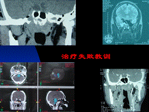 直线加速器上岗培训头颈部癌文档资料.ppt