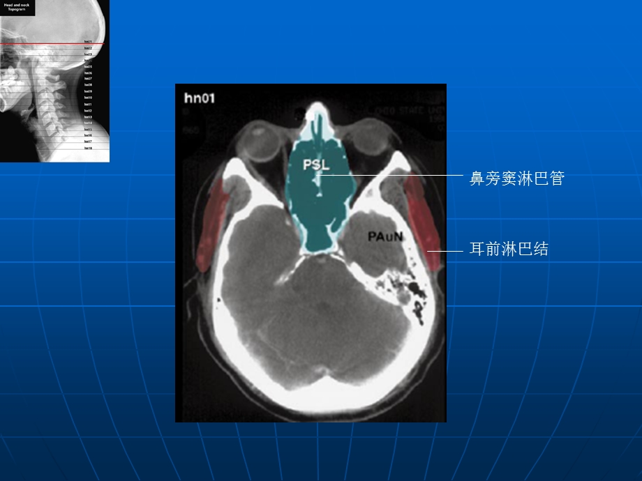 头颈部淋巴结断层.ppt_第2页