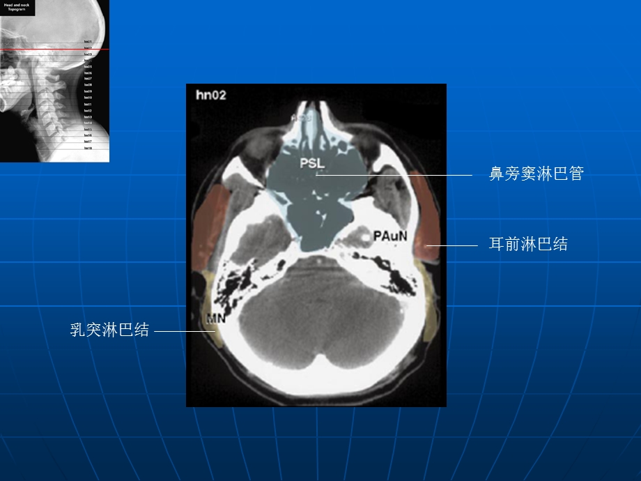 头颈部淋巴结断层.ppt_第3页