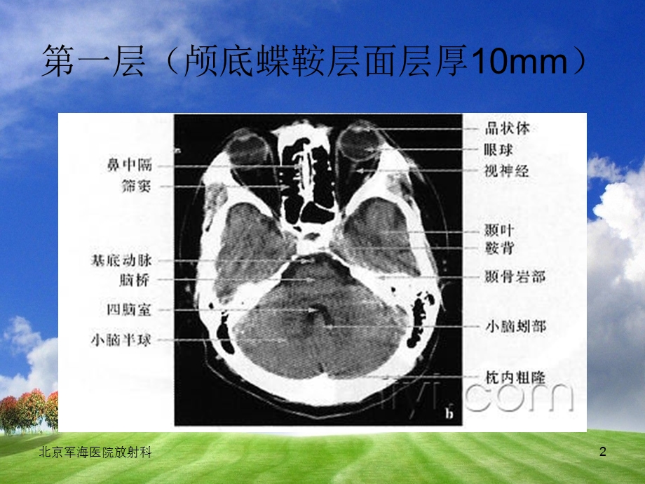 颅脑CT影像学精选文档.ppt_第2页