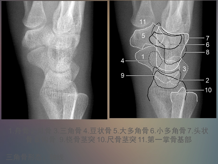 腕关节解剖文档资料.ppt_第3页