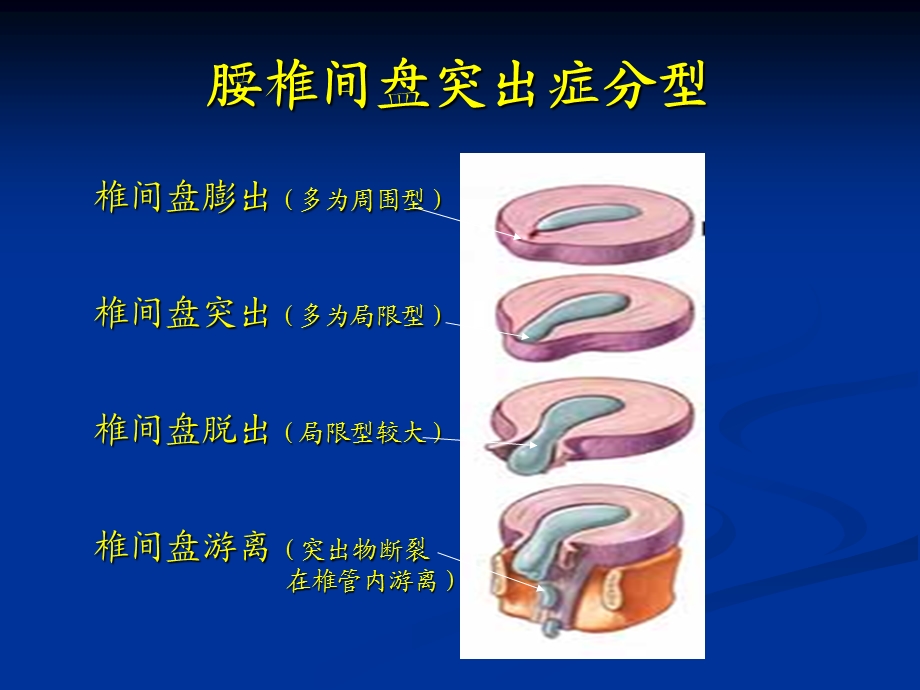 金堂龙济医院演讲椎间盘ppt课件.ppt_第3页