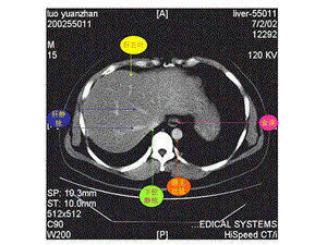 腹部CT资料2.ppt
