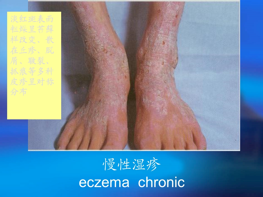 银屑病Psoriasis.ppt_第3页