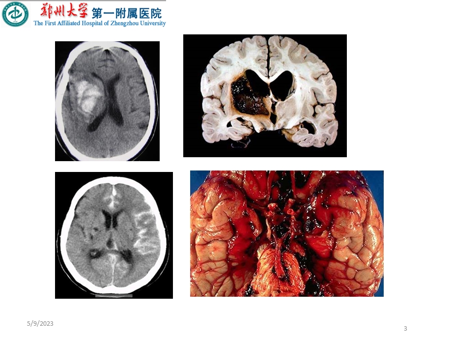 脑血管病诊治PPT文档.ppt_第3页