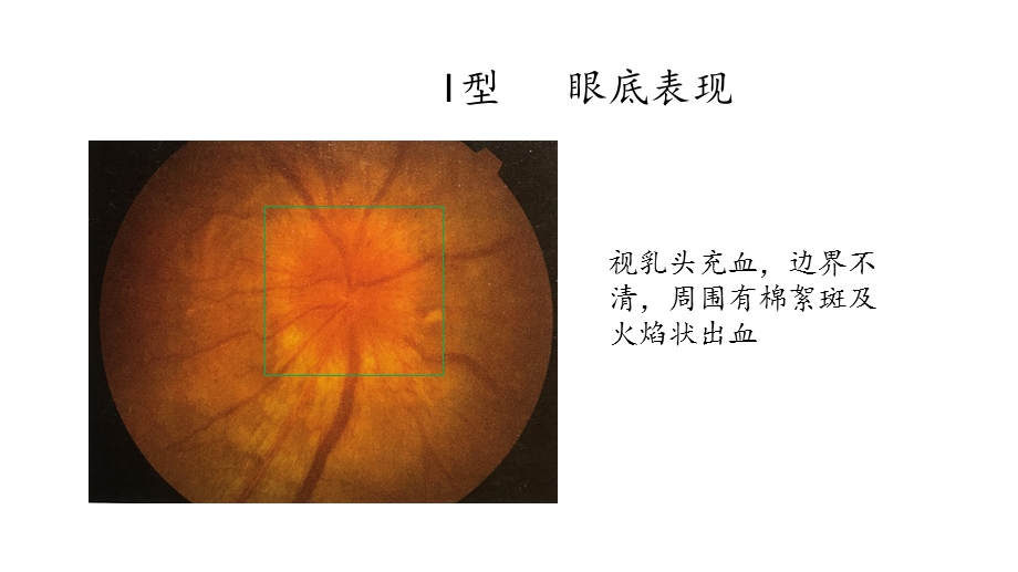 视盘血管炎精选文档.pptx_第3页