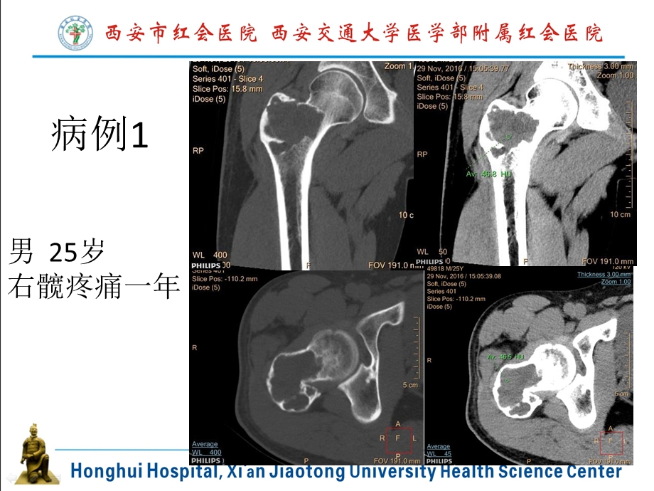 软骨母细胞瘤PPT文档.pptx_第1页