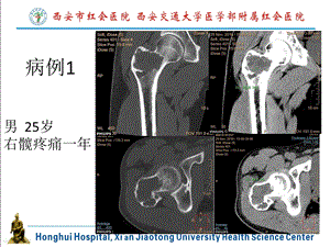 软骨母细胞瘤PPT文档.pptx