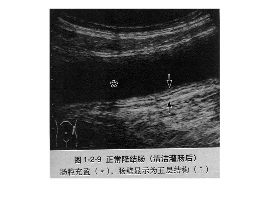 南昌大学超声精品课程之胃肠超声之二.ppt_第2页