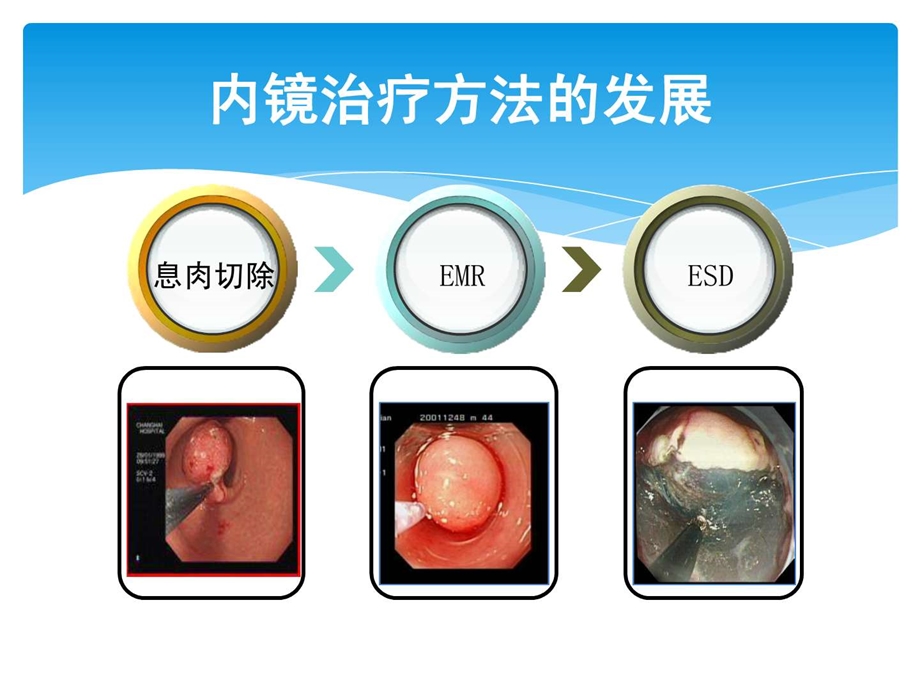 内镜下电凝电切术新.ppt.ppt_第2页