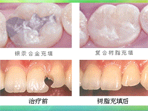 牙科树脂充填.ppt