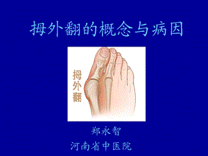 拇外翻的概念与病因ppt课件.ppt