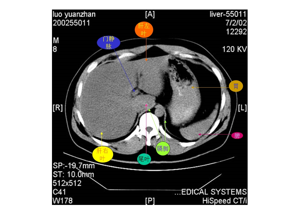 【共享】超好的腹部CT学习图片及PPT资料PPT文档.ppt_第3页