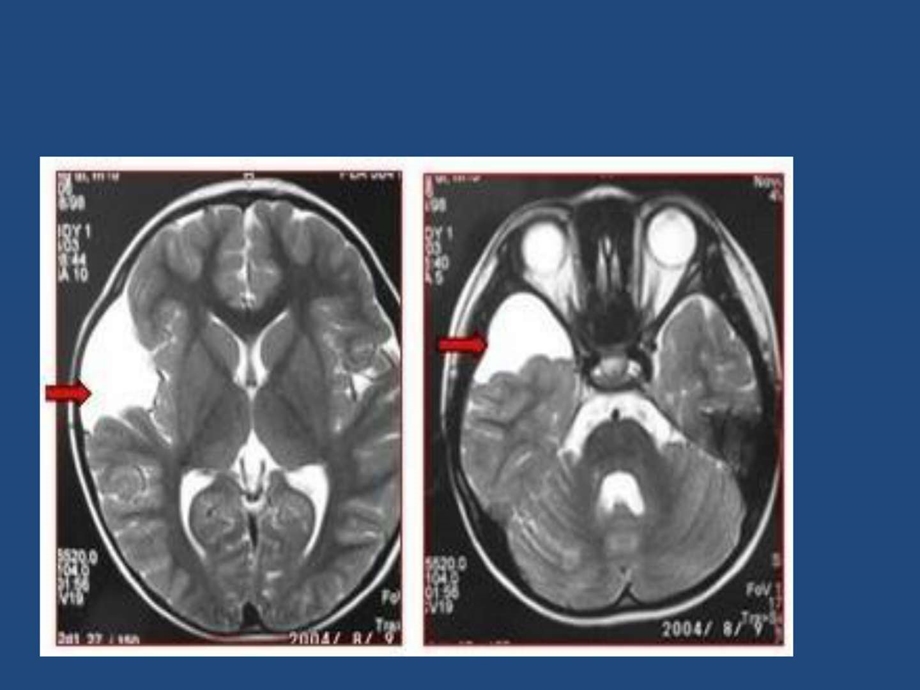 蛛网膜囊肿PPT计算机软件及应用IT计算机专业资料.ppt.ppt_第2页