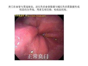 正常胃肠镜图片.ppt