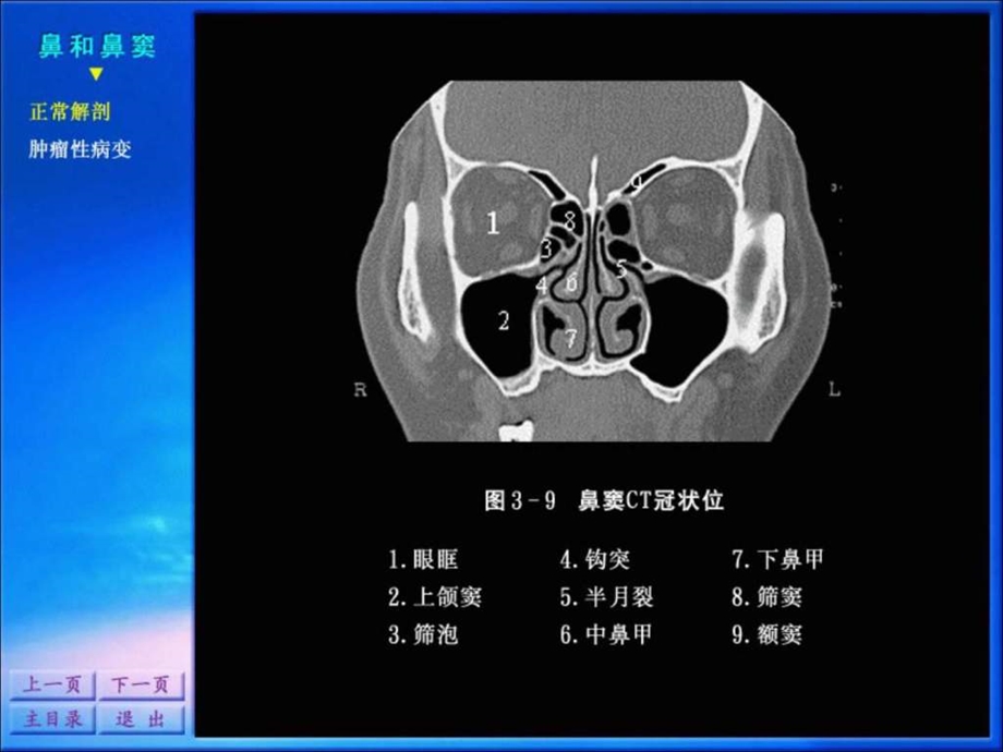 0160影像诊断学系列图谱头颈五官.ppt.ppt_第3页