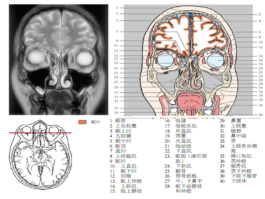 头颈CTMRI解剖图解系列4.ppt_第3页