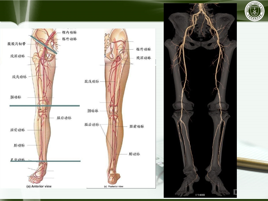 肺动脉减影cta武汉协和医院朱乐ppt课件.ppt_第2页