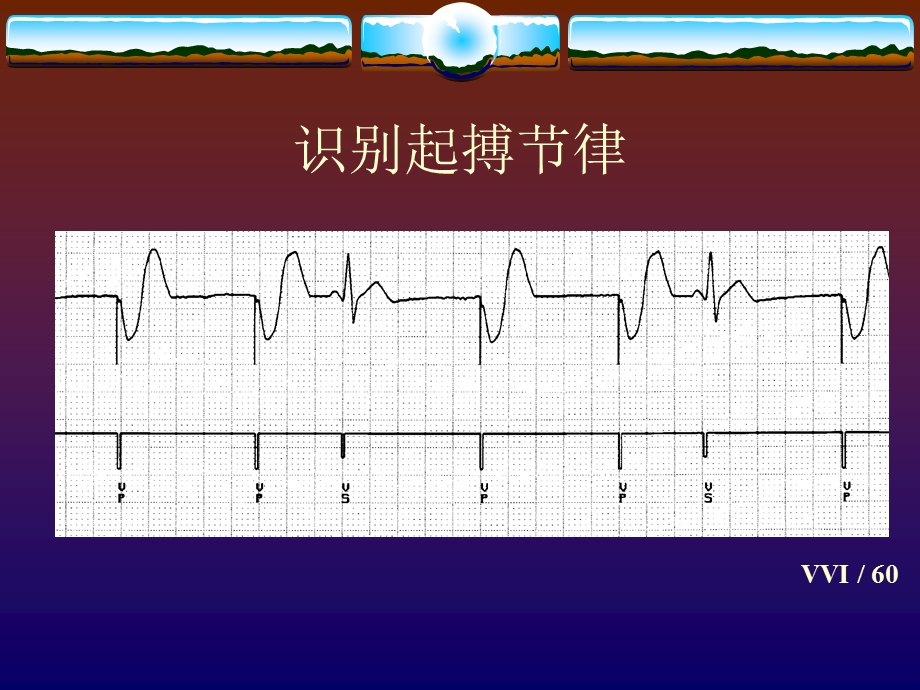 单腔起搏器的相关技术与临床心电图表现.ppt_第3页