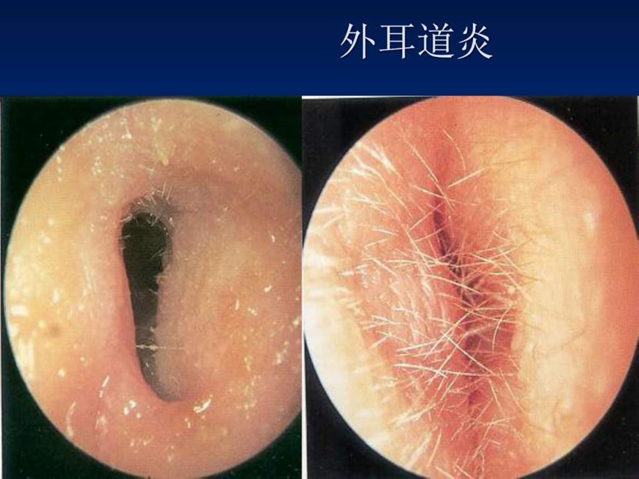 五官科护理第六章耳部常见疾病病人的护理图文.ppt.ppt_第3页