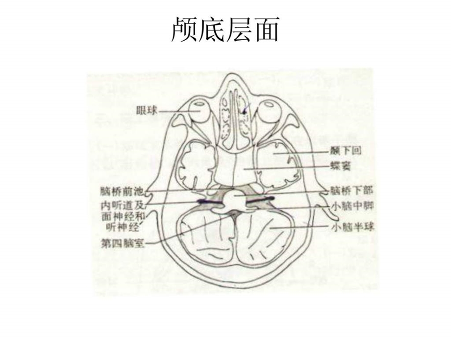 爱爱医资源脑头颅CT示意图.ppt_第2页