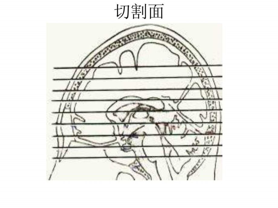 爱爱医资源脑头颅CT示意图.ppt_第3页