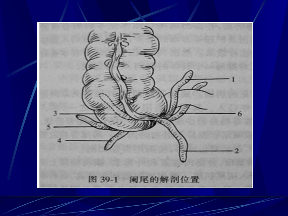 阑尾炎appendicitisppt课件.ppt_第3页