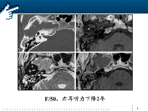 颞骨巨细胞修复性肉芽肿.ppt