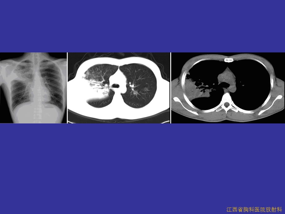 呼吸系统病例ppt课件.ppt_第2页