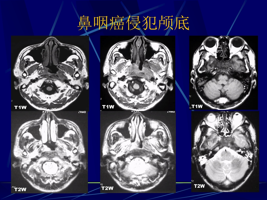 咽部影像诊断.ppt_第3页