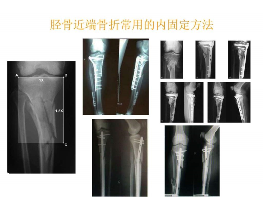 胫骨近端骨折治疗图文.ppt.ppt_第2页