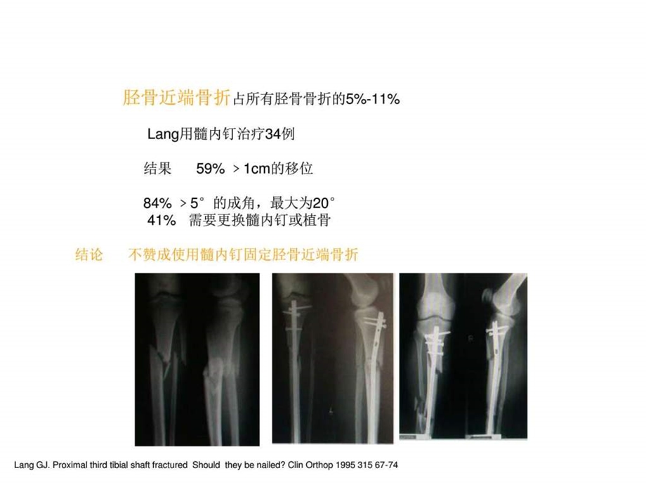 胫骨近端骨折治疗图文.ppt.ppt_第3页