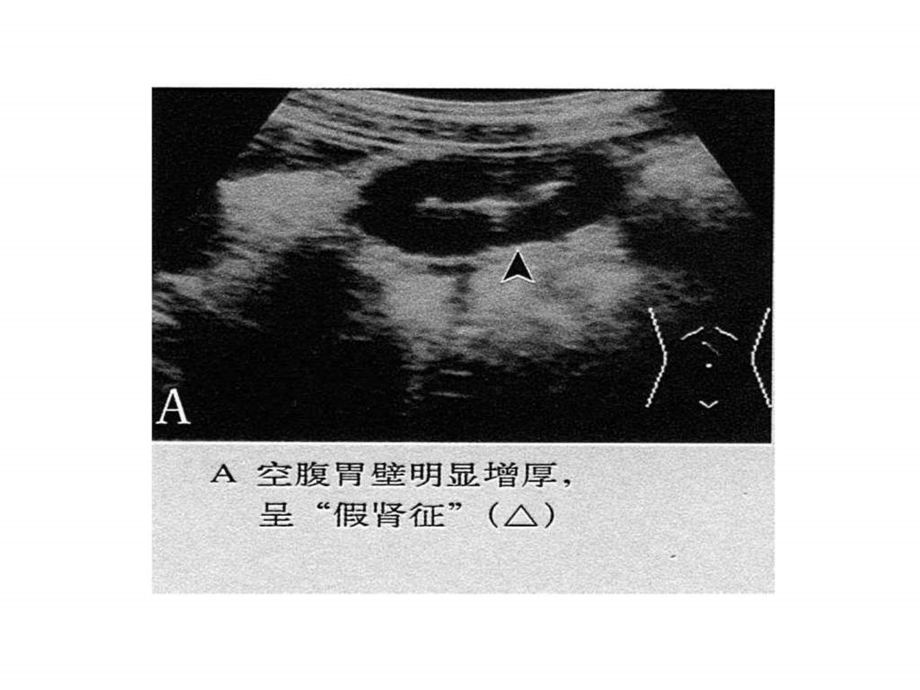 南昌大学超声精品课程之胃肠超声之三.ppt_第1页